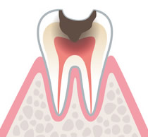 歯髄の虫歯